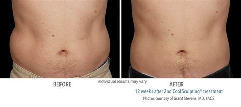 Coolsculpting crossville CoolSculpting is non-invasive cosmetic procedure for painlessly removing excess fat from various areas of the body